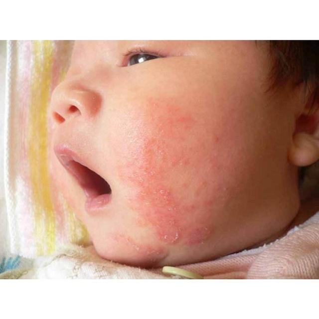宝宝患湿疹，多是饮食不注意，妈妈如何应对宝宝湿疹？