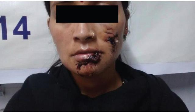 日本狂犬病发病率:被小狗咬了，没注射疫苗，这种情况会患狂犬病吗？ 日本狂犬病发病率为何低