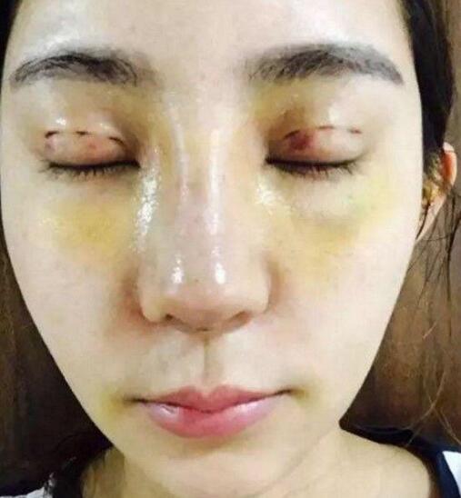 金晨整容呀对比:又有一女孩花百万整成迪丽热巴，大家怎么看待整容？