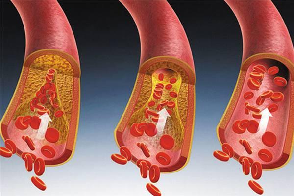 血脂稠如何调理,血脂高和血脂稠是一样的吗？