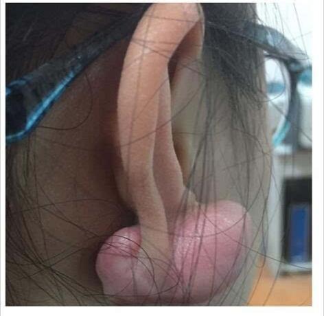 疤痕性体质(疤痕性体质是什么原因导致的)