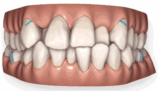 头条问答 - 隐适美和传统矫正相比,有哪些区别和优势?哪个对牙齿更好?