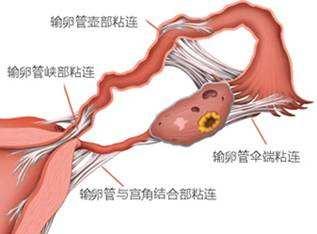 输卵管堵塞怎么治疗好?输卵管堵塞该怎么治疗