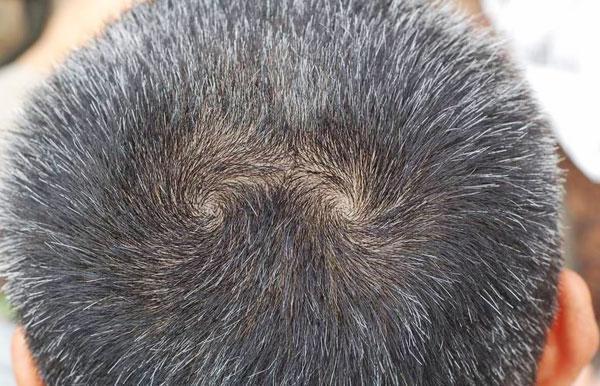 头条问答 - 头发上有两个漩涡的人真的聪明吗?