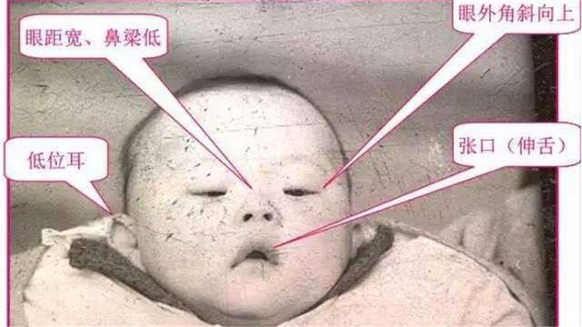 努南综合征胎儿的特点图片