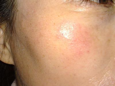 湿疹为什么是巨痒而不是疼呢？