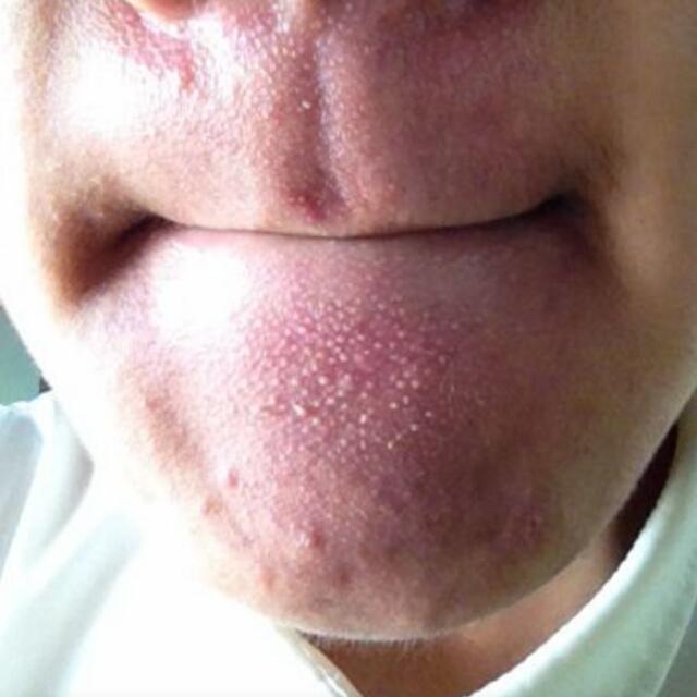 毛孔挑芝麻:下巴上的毛孔垃圾怎么清理
