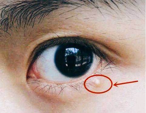 眼睛周边脂肪粒怎么去掉，眼角的脂肪粒，你们是怎么去除的