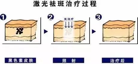 怎样祛斑不反弹(如何才能祛斑不反弹)