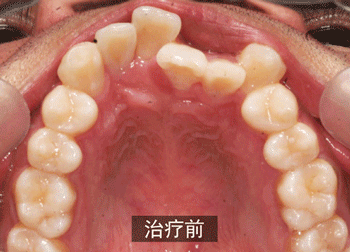 头条问答 牙齿太大挤的门牙有点往外凸 想要矫正需要拔牙吗 6个回答