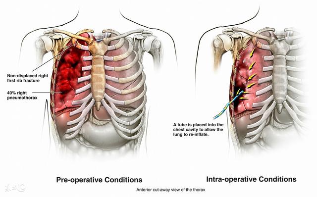 肋骨骨折怎么处理，肋骨骨折怎么胸外心脏按压？
