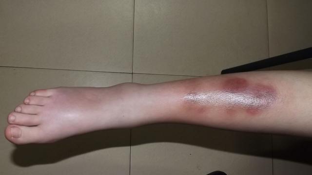 头条问答 - 小腿被撞肿后如何消肿?(2个回答)
