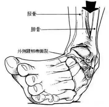 如何预防习惯性崴脚，喜欢打篮球，如何锻炼脚踝可以有效防止崴脚受伤