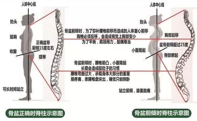 盆骨前倾怎样利用运动纠正？