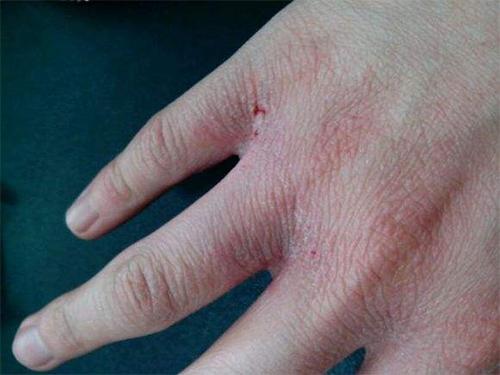 头条问答 - 冬季手干手裂还皱巴巴长湿疹,怎么护理缓解?(12个回答)