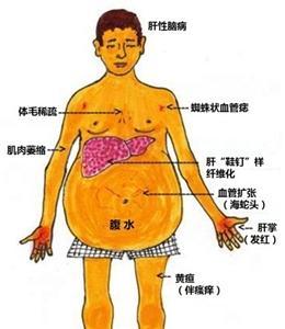 腹水症状:腹水症状四大体征 肝硬化晚期抽了腹水人会怎么样？