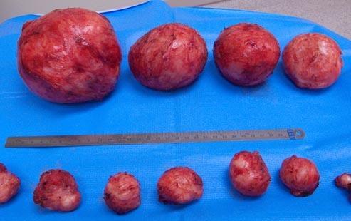 子宫肌瘤和腺肌症是一回事吗