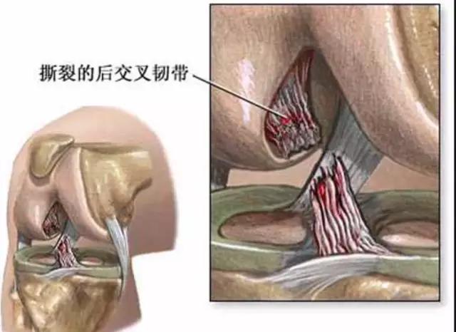 狗狗十字韧带断裂表现:前交叉韧带断裂有哪些症状呢？