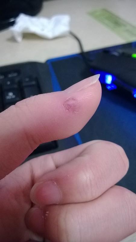 头条问答 - 手指缝里面破皮,很干燥,该怎么护理?(2个回答)