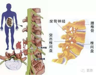 腰间盘突出为什么也会腿疼腿麻？
