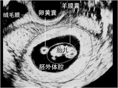 怀孕多久能做b超检查出来宫内宫外:怀孕什么时候可以查在子宫内还是子宫外？