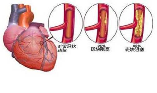 心肌缺血是怎么回事？