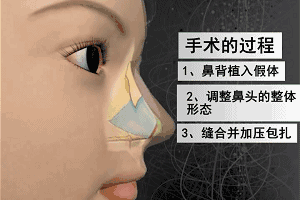 山根,隆鼻和综合隆鼻区别在哪？