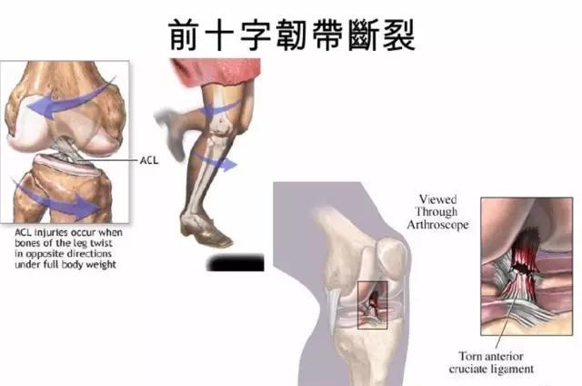 前十字韧带断裂 症状:前交叉韧带断裂有哪些症状呢？