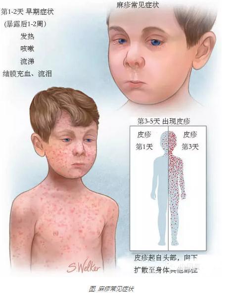 头条问答 - 麻疹和荨麻疹有什么区别?(25个回答)