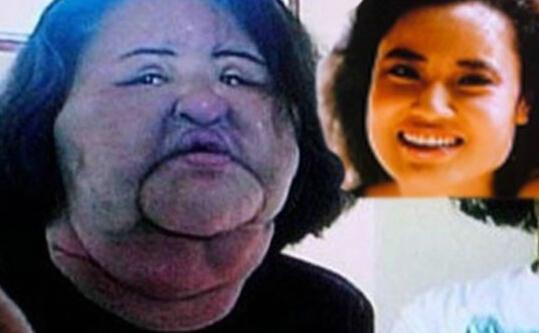 蛇精女李蒽熙:明星网红频繁整容后会留下什么后遗症？