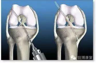 韧带断裂缝合后多久拆:前交叉韧带撕裂，是什么级别的伤病，恢复需要多久？