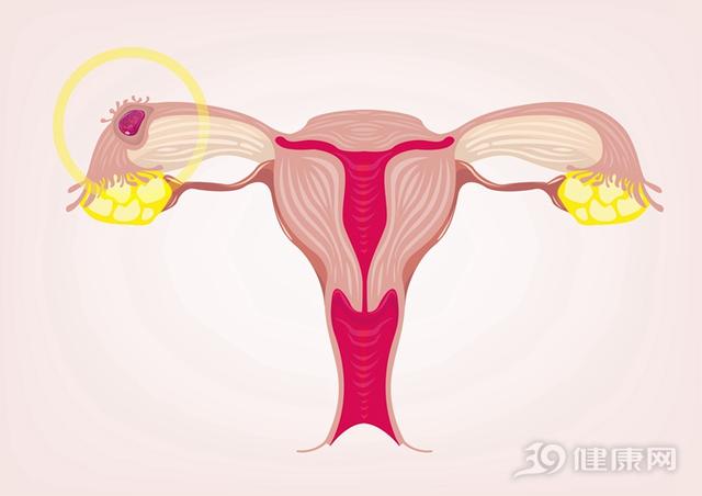 诊断宫外孕比较简单的方法是什么，诊断宫外孕比较简单的方法是什么？