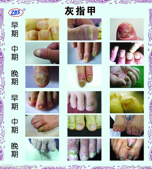什么是灰指甲图片,灰指甲容易诱发哪些疾病?