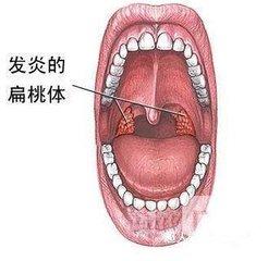 头条问答 化脓性扁桃体炎是什么感染 11个回答