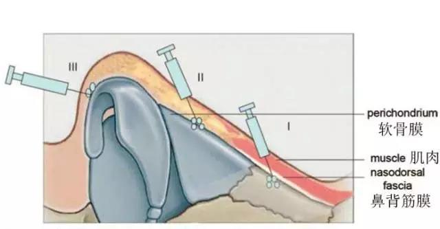 玻尿酸隆鼻效果怎么样,玻尿酸隆鼻效果怎么样呢