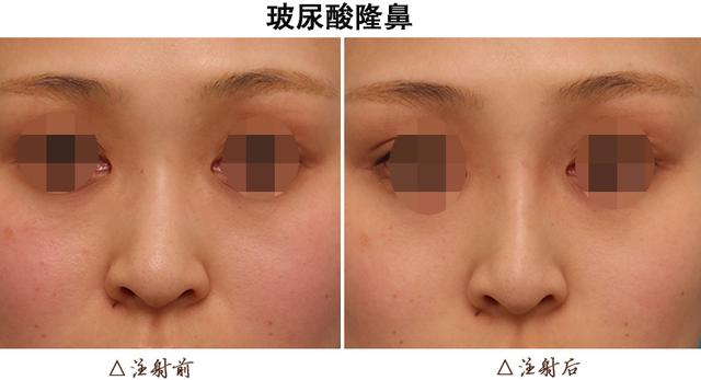 鼻综合手术拆线多少钱:鼻综合手术几天拆线 做完鼻整形修复手术后要怎么护理？