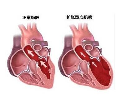 扩张性心肌病 饮食:扩张型心肌病是不是很严重？