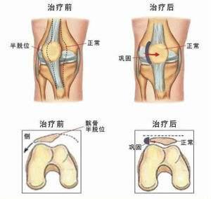 复发性髌骨脱位 概念:髌骨急性脱位，为什么医生会建议手术治疗？