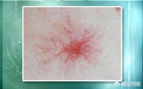蜘蛛痣:为什么出现蜘蛛痣就说肝脏功能出现问题？