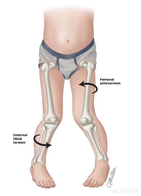 小宝缺钙会造成外八字脚吗:孩子走路内八字，怎么纠正？