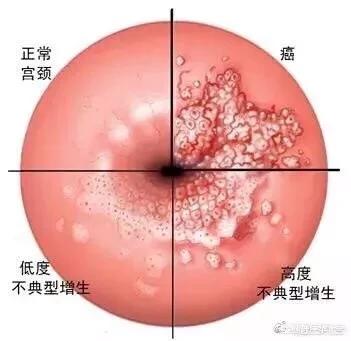 善诊健康公众号:每15分钟1位女性死于宫颈癌，如何预防宫颈癌？