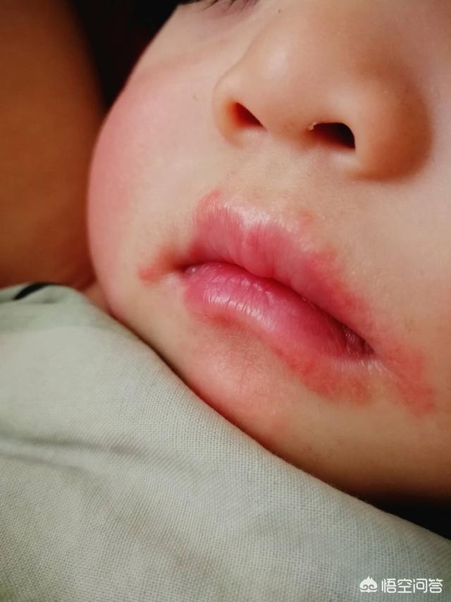 头条问答 - 如何正确的护理宝宝的口水疹?(13个回答)