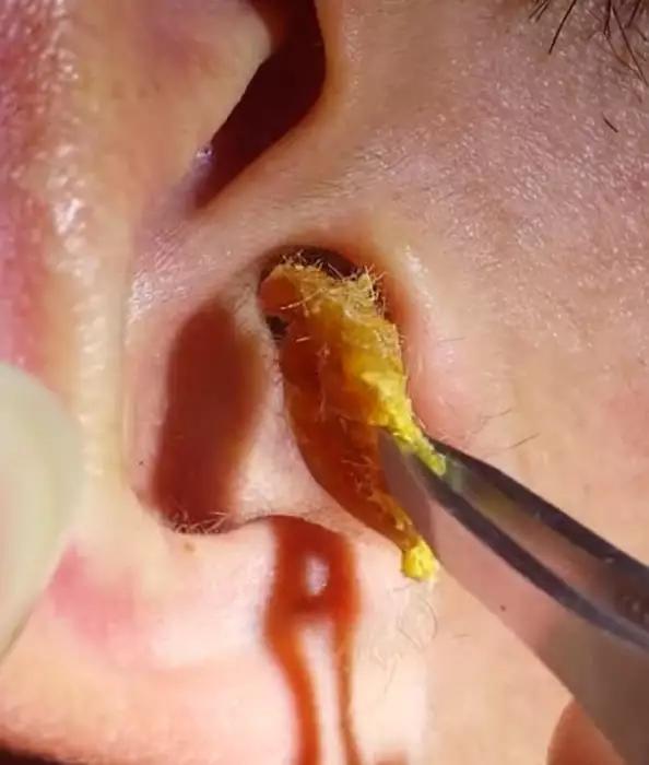 为什么那多么人喜欢看耳科赵医生发的掏耳朵视频