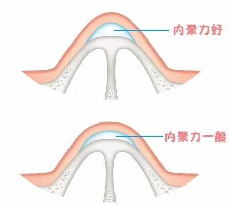鼻头塑形,玻尿酸隆鼻多次，鼻子会变吗？