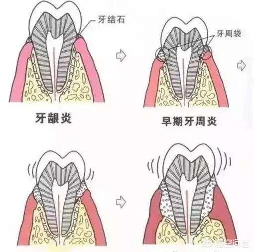 牙龈出血怎么办,牙龈出血怎么办 立刻止血