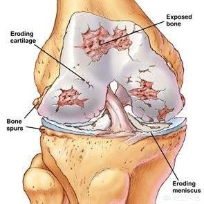 膝盖关节炎症状:关节炎半月板膝盖痒是什么原因？该怎么办？ 膝盖关节疼怎么治