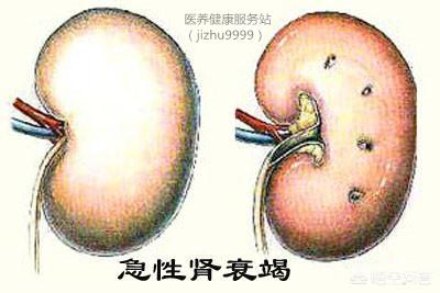 肾衰竭症状:身体出现哪些症状时，可能已进入肾衰竭晚期？