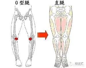 罗圈腿矫正(罗圈腿矫正手术大概需要多少钱)