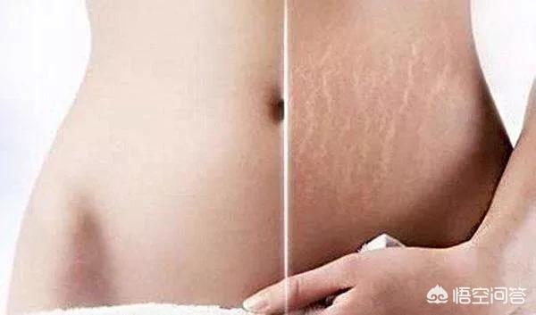 生完孩子妊娠纹该如何修复，怎样预防妊娠纹？产后妊娠纹该怎么消除？