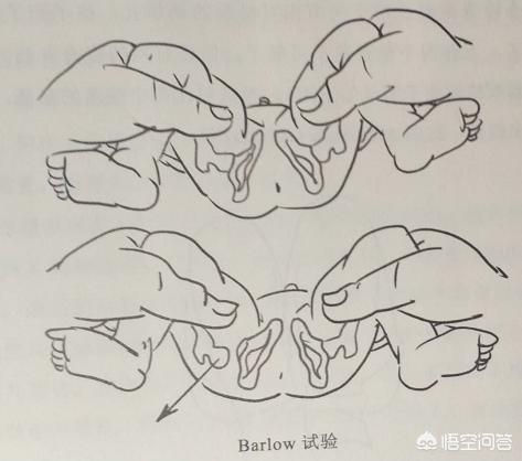 小儿髋关节脱位:小儿髋关节脱位的表现症状 如何判断宝宝是否髋关节发育不良？